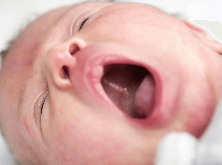 7 Cách Điều Trị Hiệu Quả Khi Bé Bị Viêm Loét Miệng Họng Sốt Cao