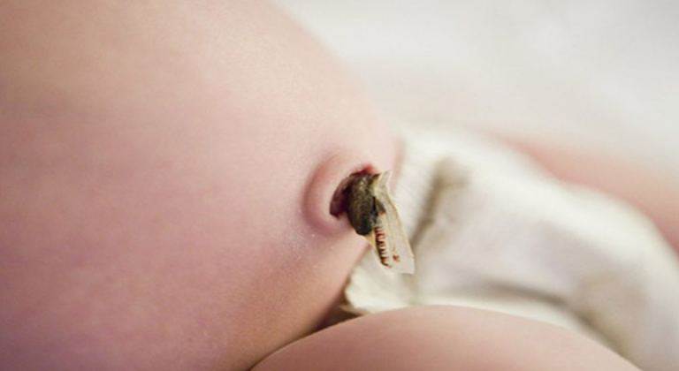 xử lý chồi rốn ở trẻ sơ sinh