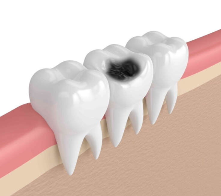 Hình Thái Răng Hàm Khiến Sâu Răng Hàm Ở Trẻ 7 Tuổi