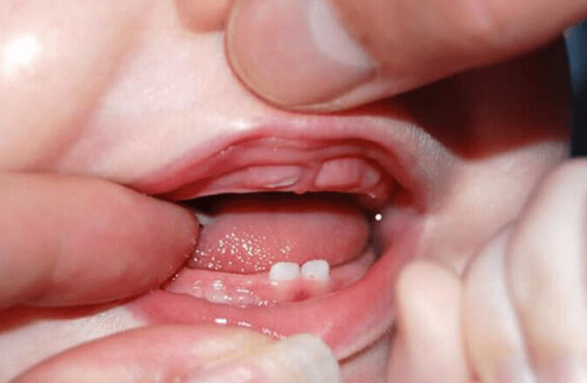 sưng lợi mọc răng ở trẻ