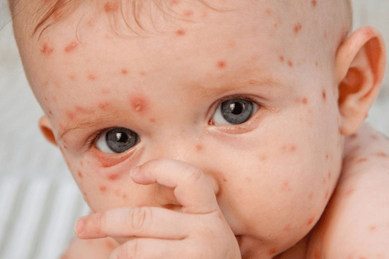 Viêm da virus ở trẻ em