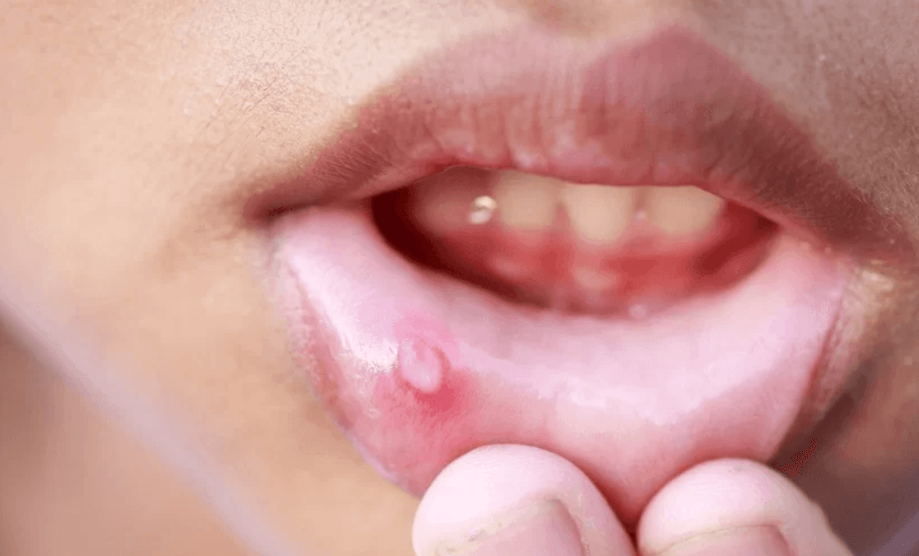 em bé bị lở miệng
