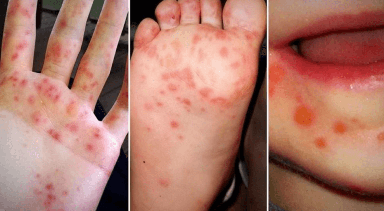 bé bị tay chân miệng lần 2