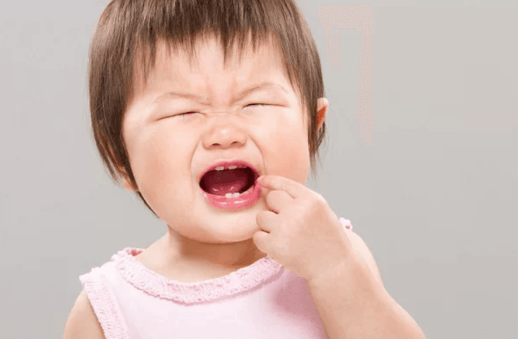 Triệu chứng viêm nướu ở trẻ em