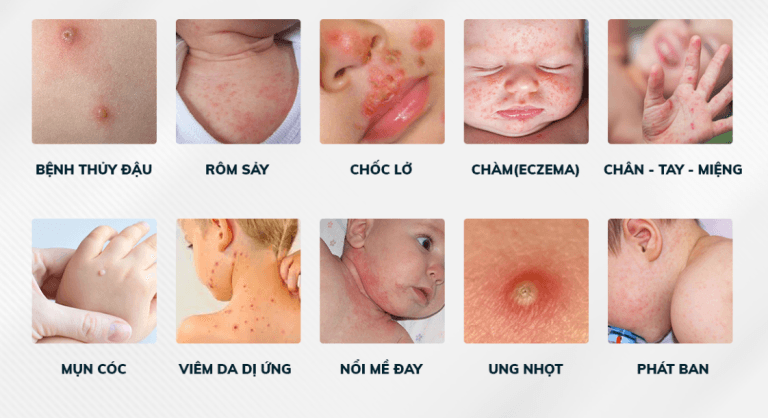 Các bệnh về da ở trẻ sơ sinh