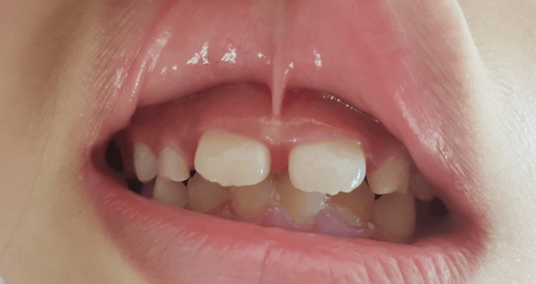 bé bị dính thắng môi trên