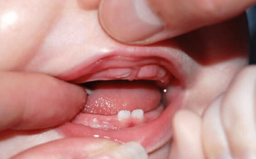 sưng lợi mọc răng ở trẻ sưng lợi mọc răng ở trẻ