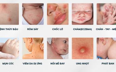 Các bệnh về da ở trẻ sơ sinh Các bệnh về da ở trẻ sơ sinh